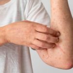 What to Look Out For: the Symptoms of Syphilis
