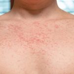 What to Look Out For: the Symptoms of Syphilis
