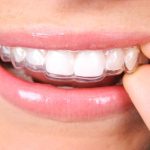 Do You Have to Wear Retainers Forever After Invisalign